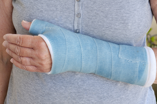 A woman with a bone fracture using natural treatments to speed fracture healing